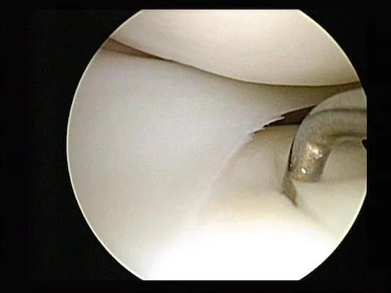 artroscopia de rodilla