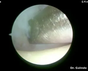 artroscopia pulgar