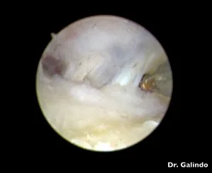 artroscopia pulgar