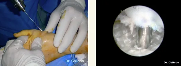 Rizartrosis