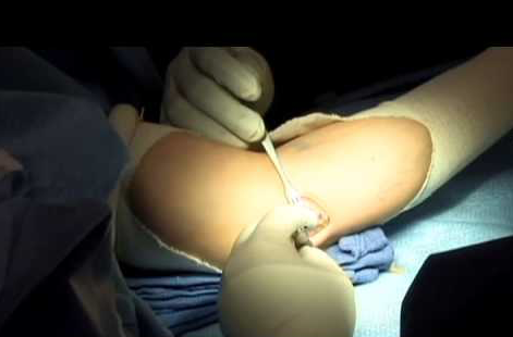 atrapamiento nervio cubital