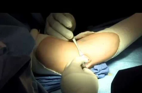 atrapamiento nervio cubital