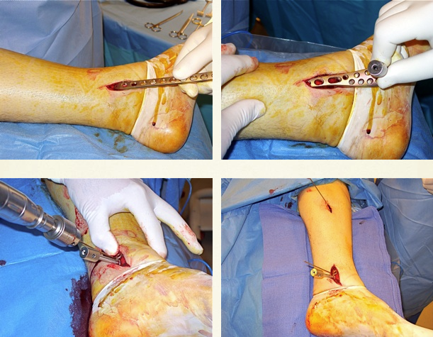cirugia pilon tibial