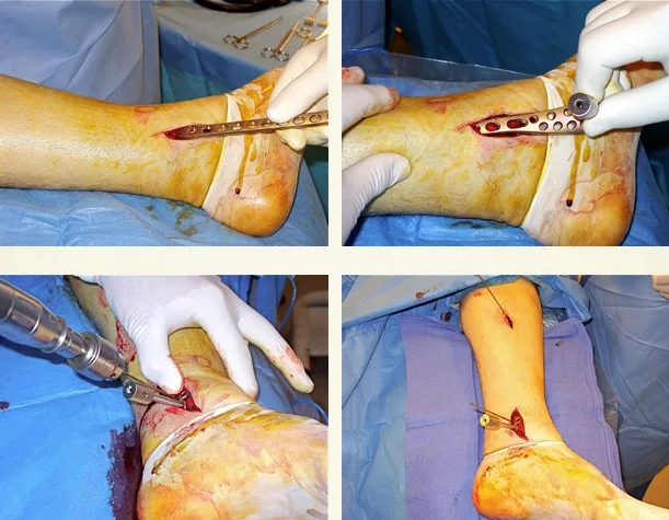 cirugia pilon tibial