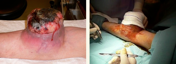 cirugia tumor brazo 01