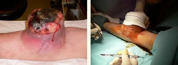 cirugia tumor brazo 01
