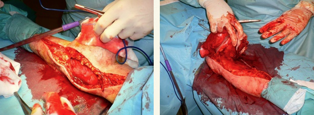 cirugia tumor brazo 02