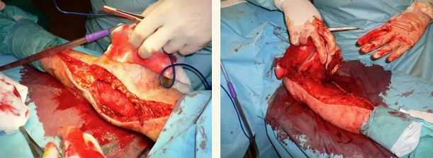 cirugia tumor brazo 02