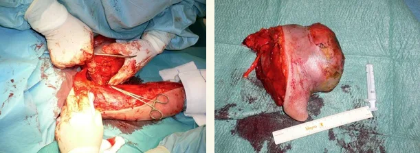 cirugia tumor brazo 03