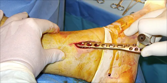 fractura de tibia