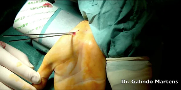 fractura escafoides