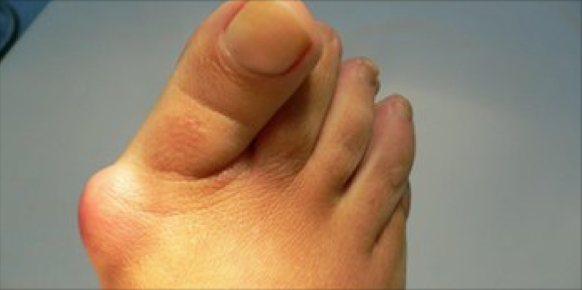 Juanete o hallux valgus
