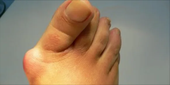 Juanete o hallux valgus