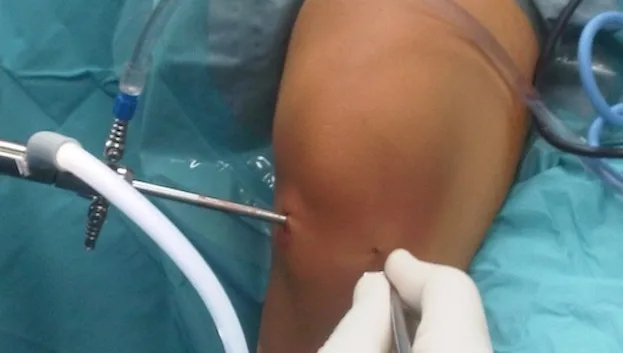 ligamento-cruzado-anterior