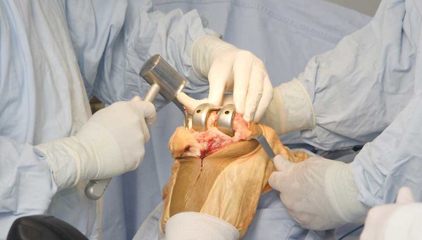 protesis total de rodilla