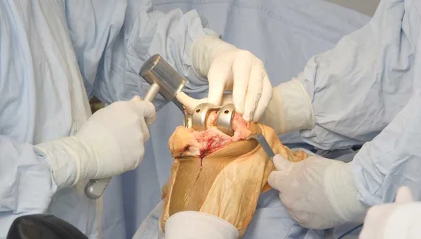 protesis total de rodilla