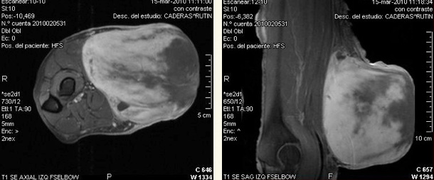 rmn tumor brazo