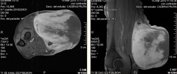 rmn tumor brazo
