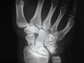 rx fractura escafoides