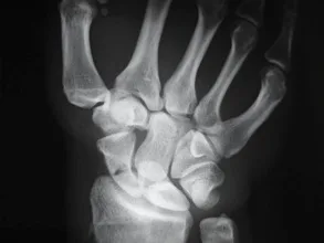 rx fractura escafoides
