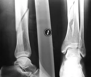 rx fractura pierna