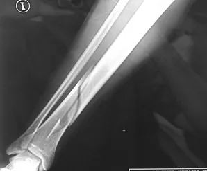 rx fractura tibia