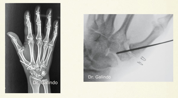 rx mano Rizartrosis