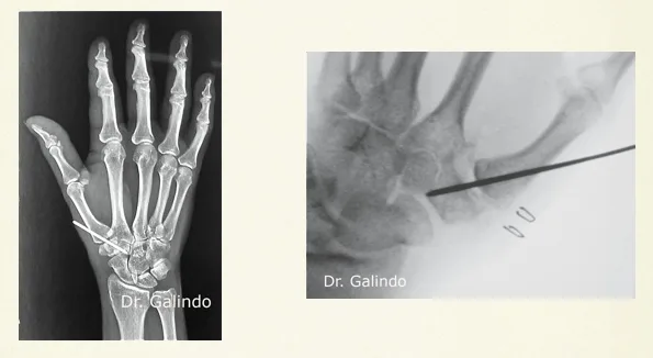 rx mano Rizartrosis