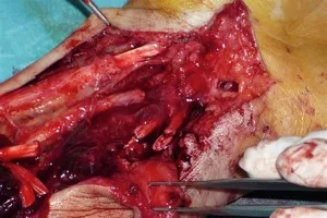 seccion tendon flexor