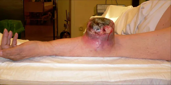 tumor brazo