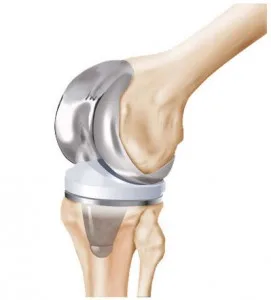 protesis rodilla galindo